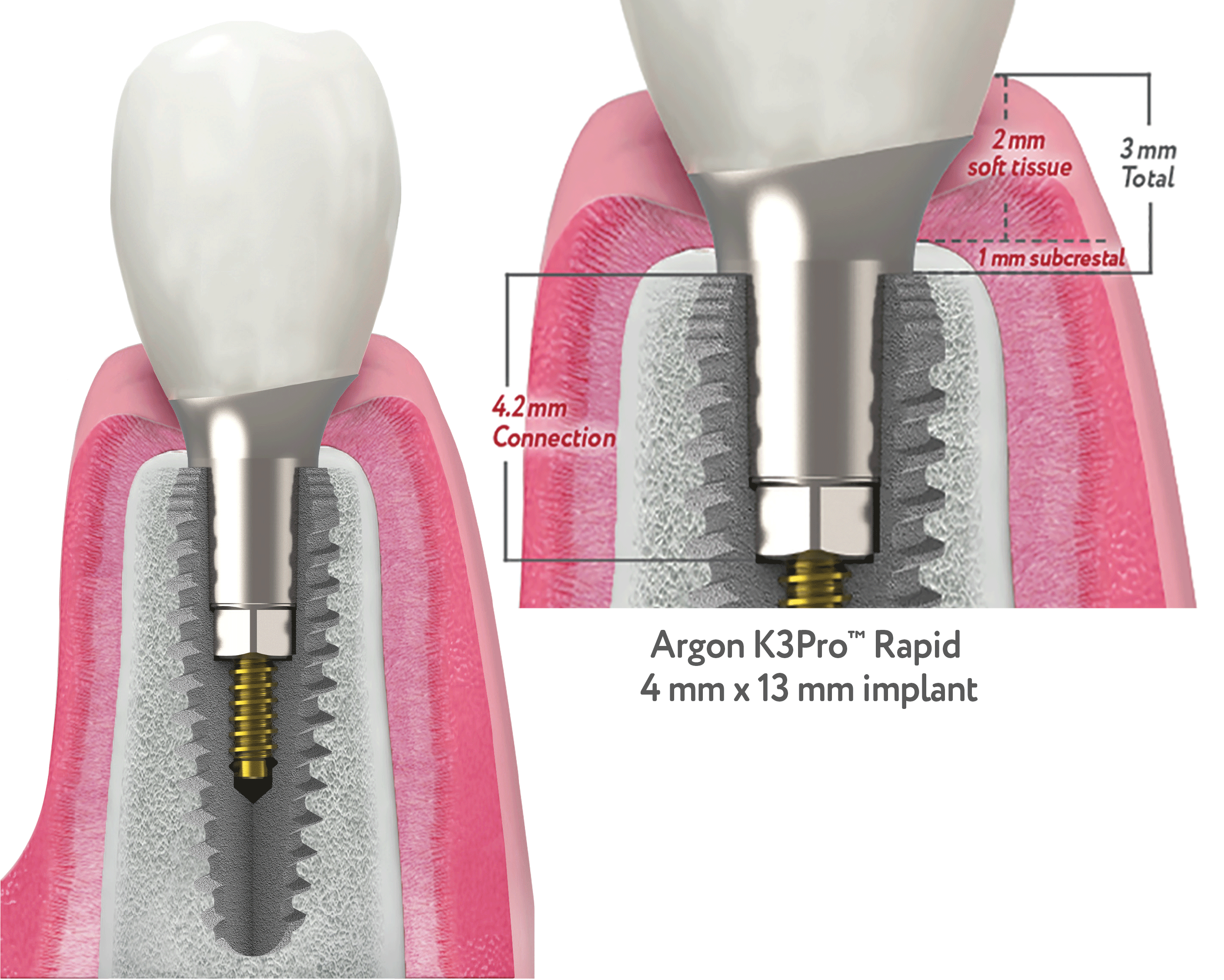 argonk3proimplant_6